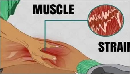 肌肉运动拉伤怎么办_肌肉能运动拉伤吗_肌肉拉伤能运动吗